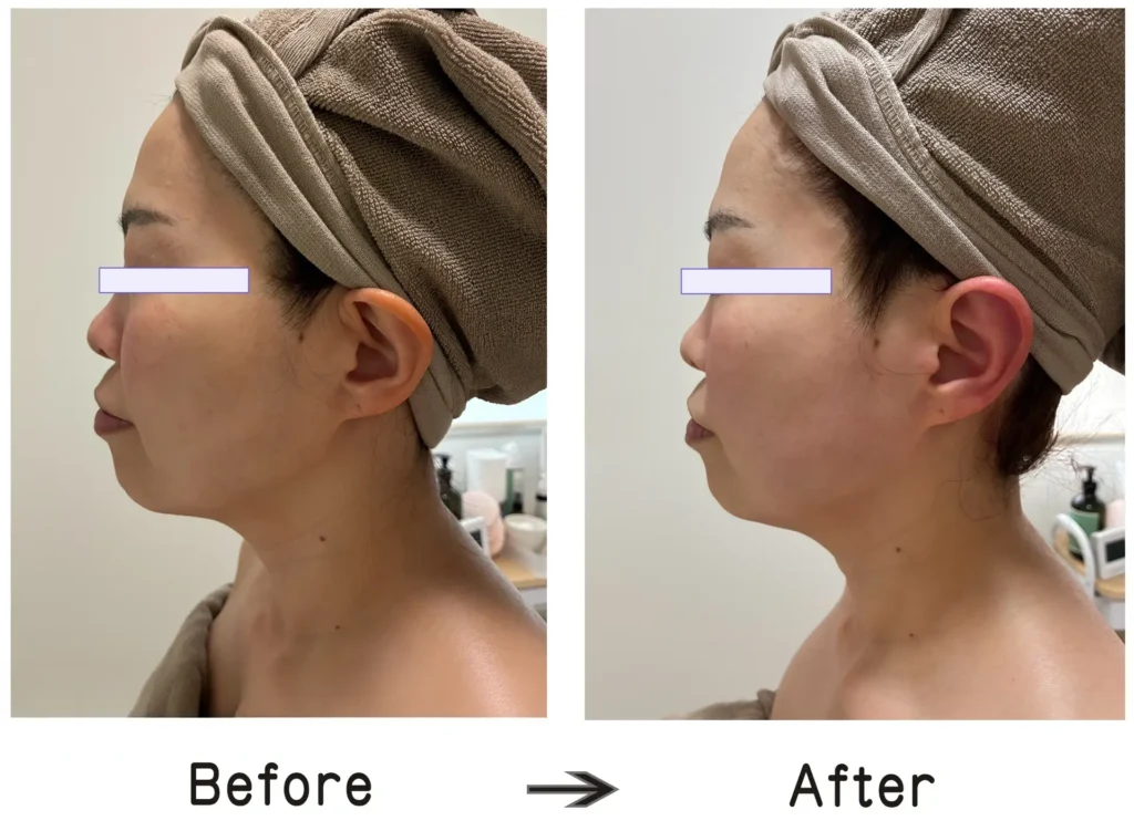 美整筋メソッド施術例